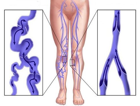 Comparación de efectos venosos después de usar Veniselle y efectos venosos