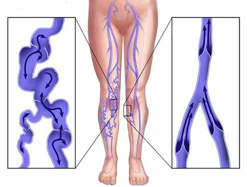 Comparación de venas y venas afectadas por las venas después de usar Veniselle