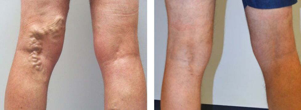 Fotos antes y después de usar Veniselle, experiencia con crema