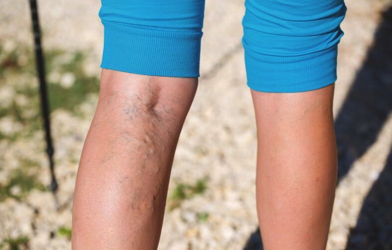 Daño inferior a las extremidades