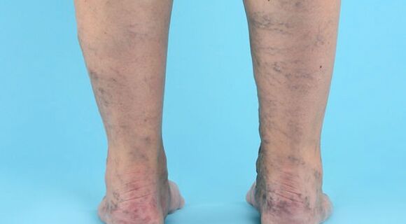 Enfermedad varicocele