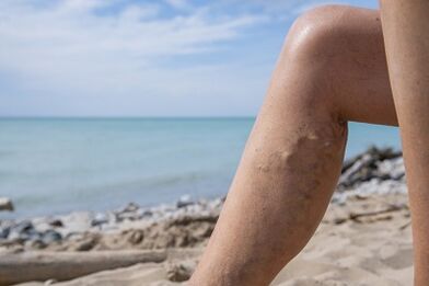 Venas en las piernas