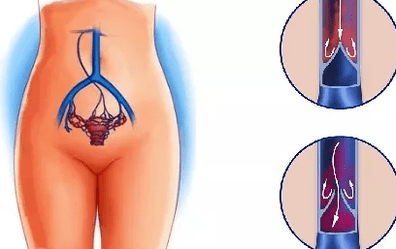 Causas del desarrollo de la varicosa pélvica