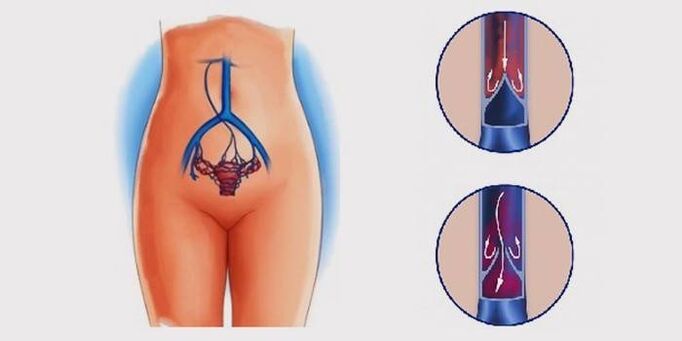 venas varicosas pélvicas