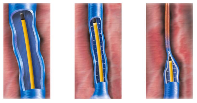 Ablación por radiofrecuencia como tratamiento de las varices