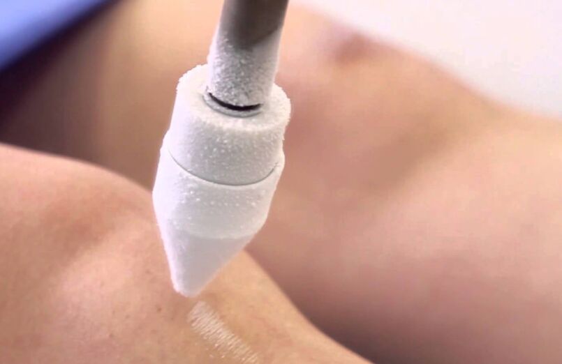 Crioterapia para tratar las varices en las piernas