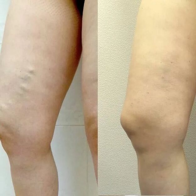 Antes y después del tratamiento de varices